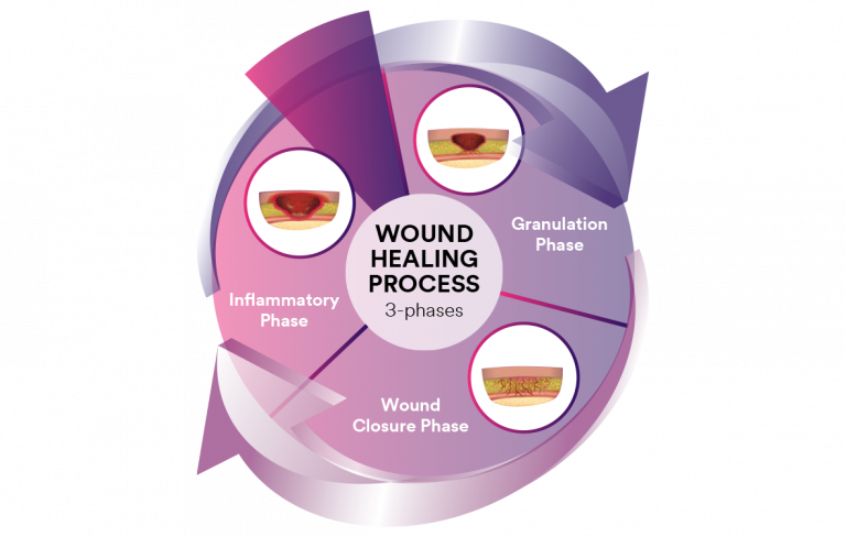 Wound healing process image describing stages