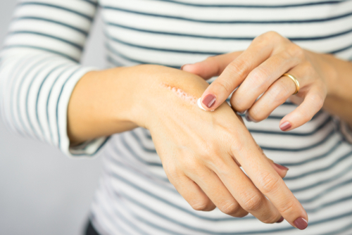 woman with scar on hand