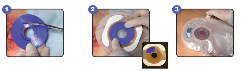 Hydrofera-Application ostomy instruction Picture